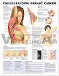 Understanding Breast Cancer Anatomical Chart, 1st Edition - Styrene Plastic